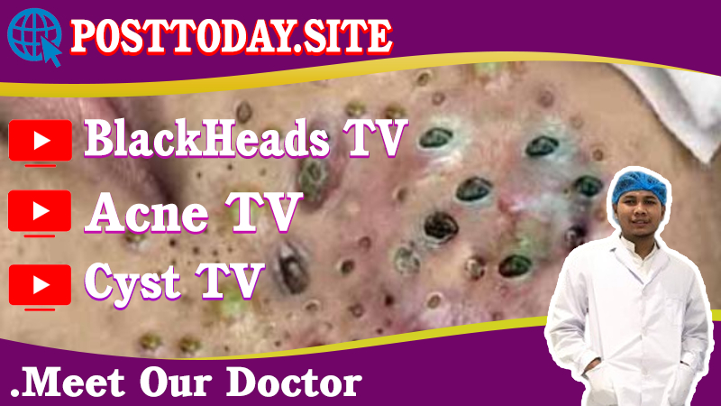 Treatment of acne tablets, pustules and blackheads